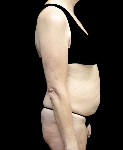 Tummy Tuck Before & After Patient #24487
