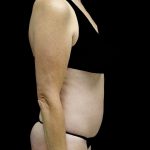Tummy Tuck Before & After Patient #24487