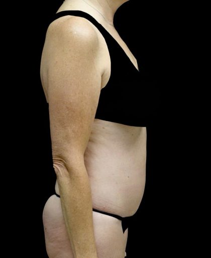 Tummy Tuck Before & After Patient #24487