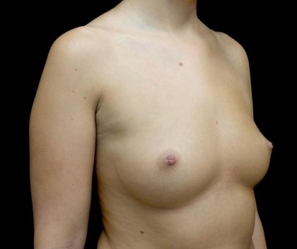 Breast Augmentation (Implants) Before & After Patient #24486