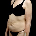 Tummy Tuck Before & After Patient #24487