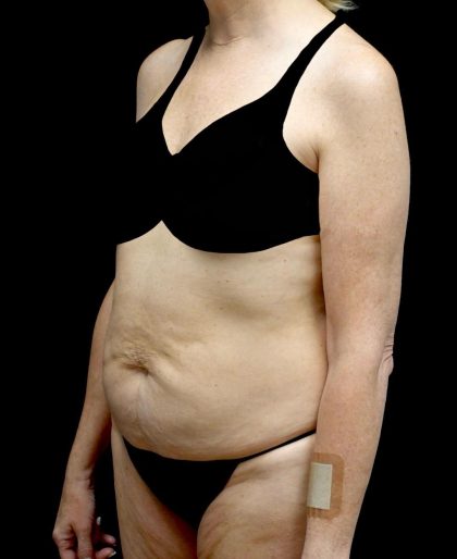 Tummy Tuck Before & After Patient #24487