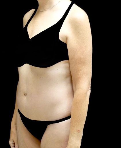 Tummy Tuck Before & After Patient #24487