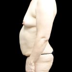 Breast Lift with Implants Before & After Patient #24488