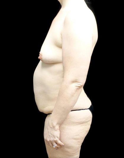 Breast Lift with Implants Before & After Patient #24488
