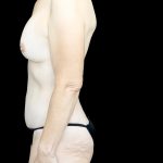 Breast Lift with Implants Before & After Patient #24488