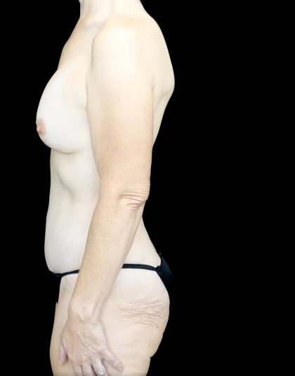 Breast Lift with Implants Before & After Patient #24488