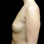 Breast Augmentation (Implants) Before & After Patient #24486