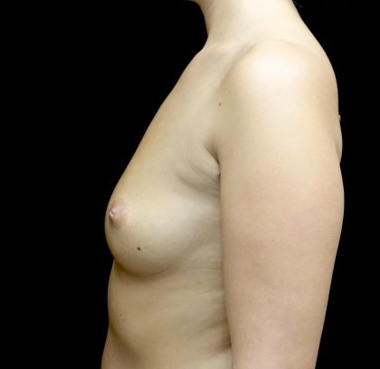 Breast Augmentation (Implants) Before & After Patient #24486