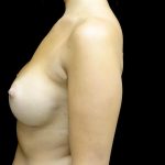 Breast Augmentation (Implants) Before & After Patient #24486