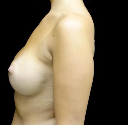 Breast Augmentation (Implants) Before & After Patient #24486