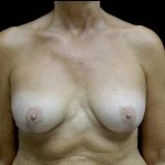 Breast Revision Before & After Patient #24515