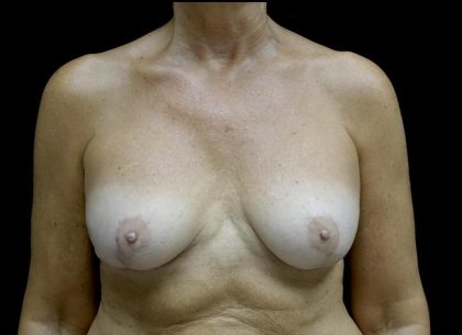 Breast Revision Before & After Patient #24515