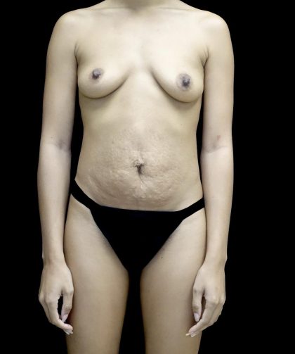 Breast Augmentation (Implants) Before & After Patient #24516