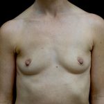 Breast Augmentation (Implants) Before & After Patient #24517