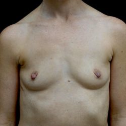Breast Augmentation (Implants) Before & After Patient #24517