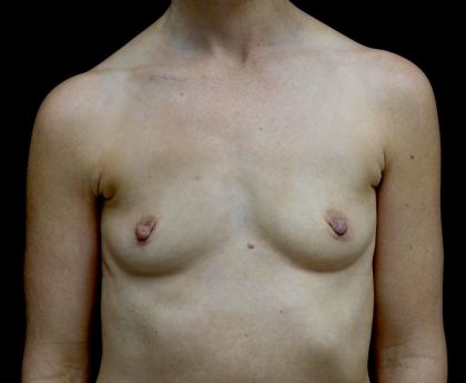 Breast Augmentation (Implants) Before & After Patient #24517