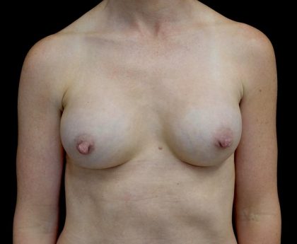 Breast Augmentation (Implants) Before & After Patient #24517