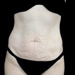 Tummy Tuck Before & After Patient #24518