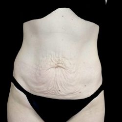 Tummy Tuck Before & After Patient #24518