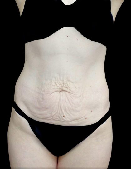 Tummy Tuck Before & After Patient #24518