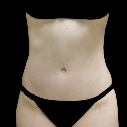 Tummy Tuck Before & After Patient #24518