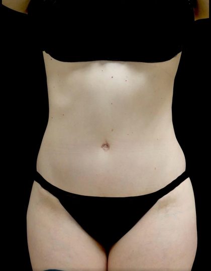 Tummy Tuck Before & After Patient #24518
