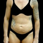 Tummy Tuck Before & After Patient #24576