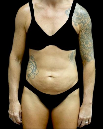 Tummy Tuck Before & After Patient #24576