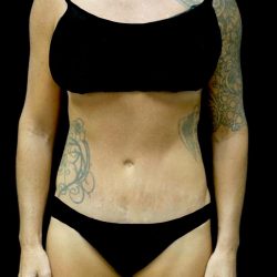 Tummy Tuck Before & After Patient #24576