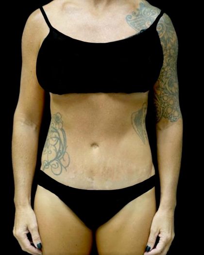 Tummy Tuck Before & After Patient #24576