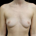 Breast Augmentation (Fat Transfer) Before & After Patient #24577