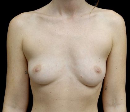 Breast Augmentation (Fat Transfer) Before & After Patient #24577