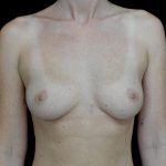 Breast Augmentation (Fat Transfer) Before & After Patient #24577