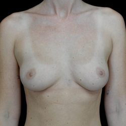 Breast Augmentation (Fat Transfer) Before & After Patient #24577