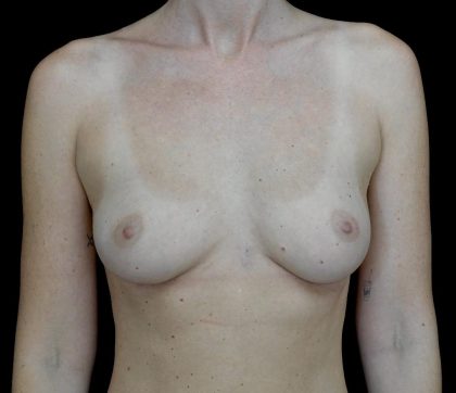 Breast Augmentation (Fat Transfer) Before & After Patient #24577