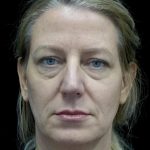 Blepharoplasty Before & After Patient #24578