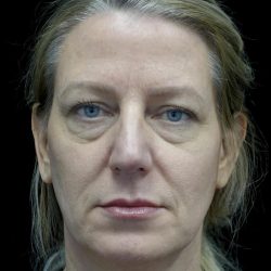 Blepharoplasty Before & After Patient #24578