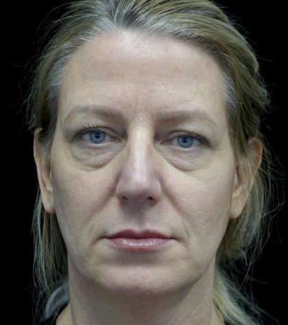 Blepharoplasty Before & After Patient #24578