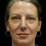 Blepharoplasty Before & After Patient #24578