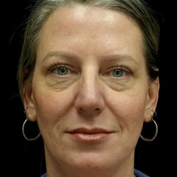 Blepharoplasty Before & After Patient #24578