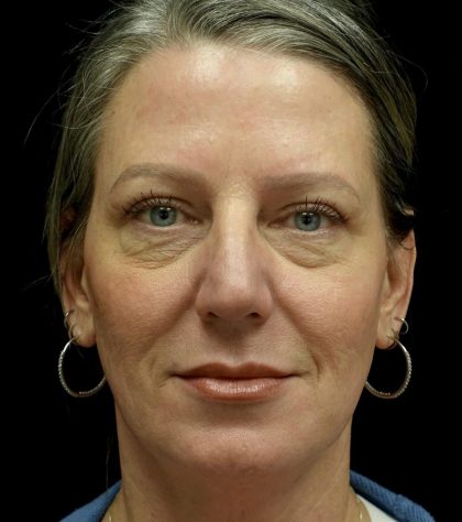 Blepharoplasty Before & After Patient #24578