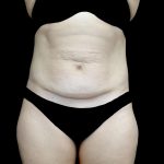 Tummy Tuck Before & After Patient #24579