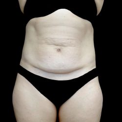 Tummy Tuck Before & After Patient #24579