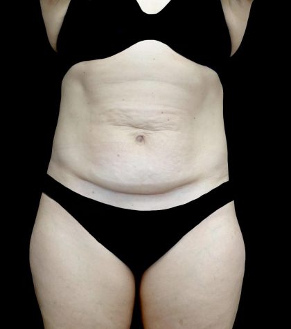 Tummy Tuck Before & After Patient #24579