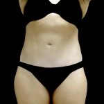 Tummy Tuck Before & After Patient #24579