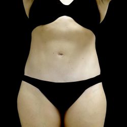 Tummy Tuck Before & After Patient #24579