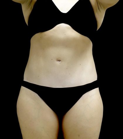 Tummy Tuck Before & After Patient #24579