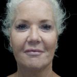 Facelift Before & After Patient #24508