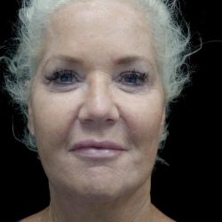 Facelift Before & After Patient #24508